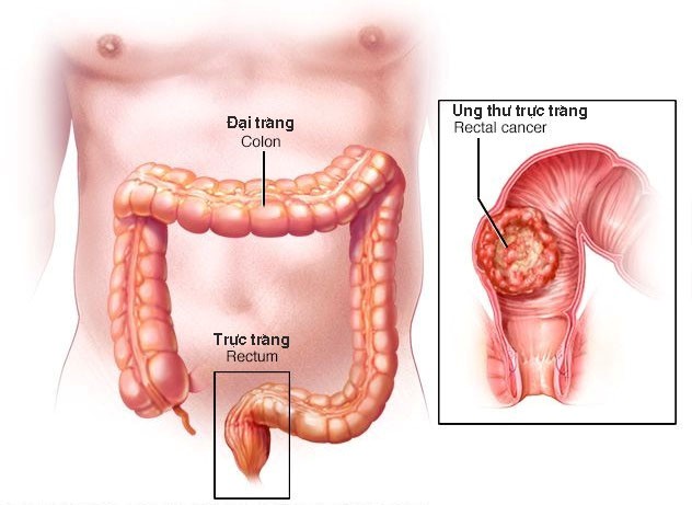 Mổ Ung Thư Trực Tràng: Hướng Dẫn Chi Tiết và Lợi Ích Vượt Trội