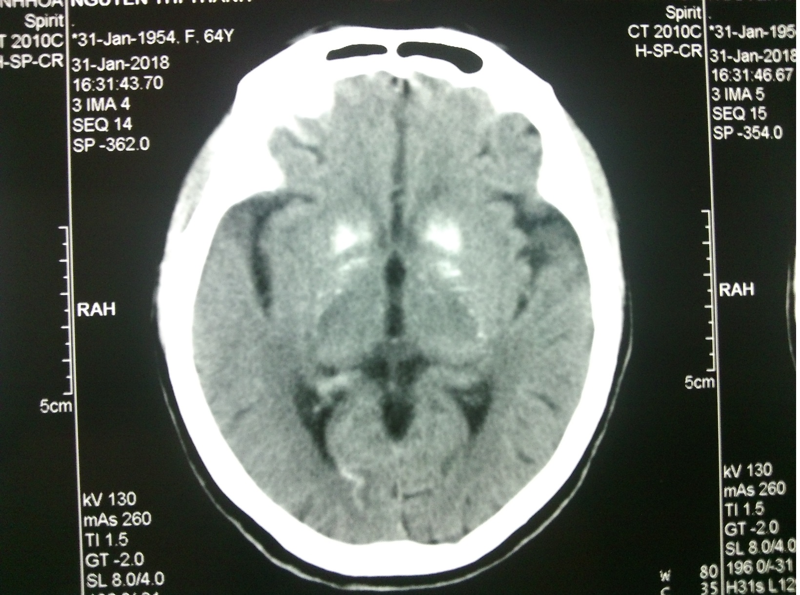 So sánh giữa chụp MRI và chụp CT Scan | PK BV Đại học Y Dược 1