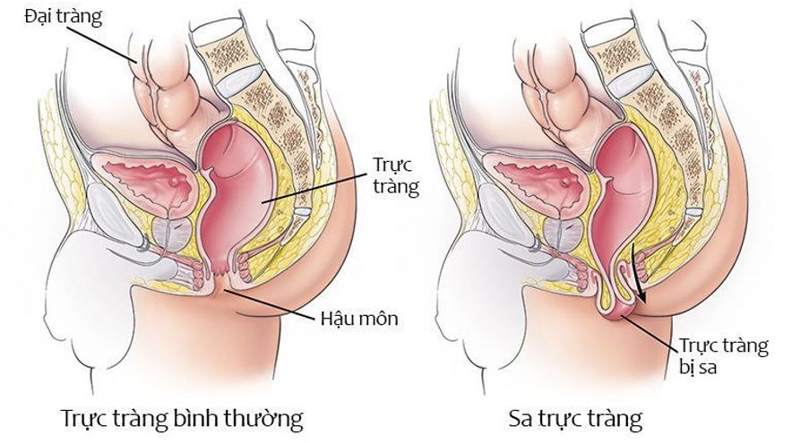 Phẫu thuật Altemeier: Giải pháp hiệu quả điều trị sa trực tràng